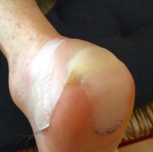 1 Blister Plasters Bob's Ankle